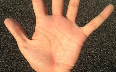 Genetics “Trisomy 21”