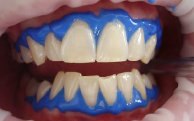 Hellere Zähne durch Bleaching